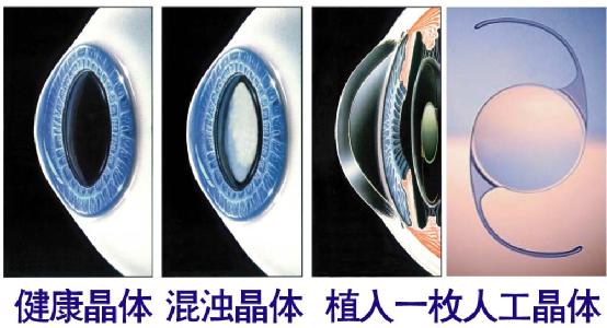 超聲乳化手術(shù)白內(nèi)障危險(xiǎn)嗎？