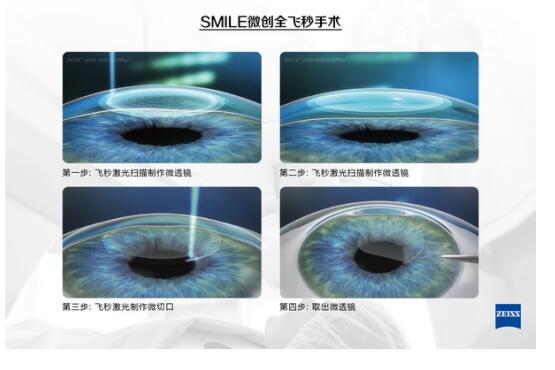 有近視，全飛秒激光手術(shù)后視力更好