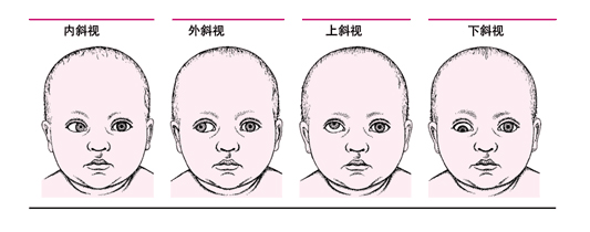 什么是斜視？斜視能嗎？
