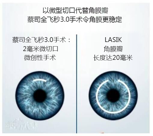 做完近視手術要休息多長時間？需要住院嗎？