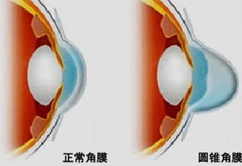 圓錐角膜，哪種角膜移植術(shù)好？