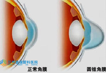 圓錐角膜怎樣？
