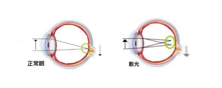 高度散光加近視可以做手術(shù)嗎？