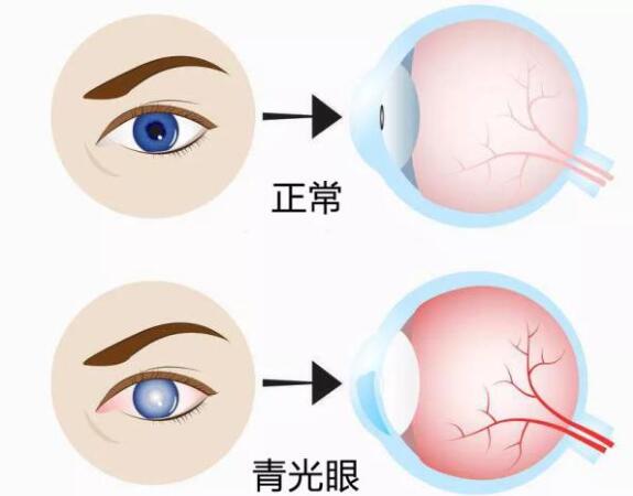 第17個青光眼周｜共管慢病青光眼，留得光明恒久遠(yuǎn)